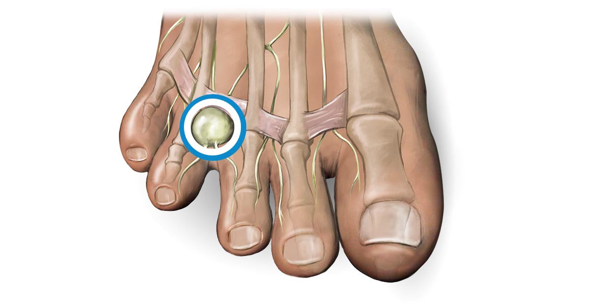 The Effectiveness of Morton’s Neuroma Surgery: What You Need to Know
